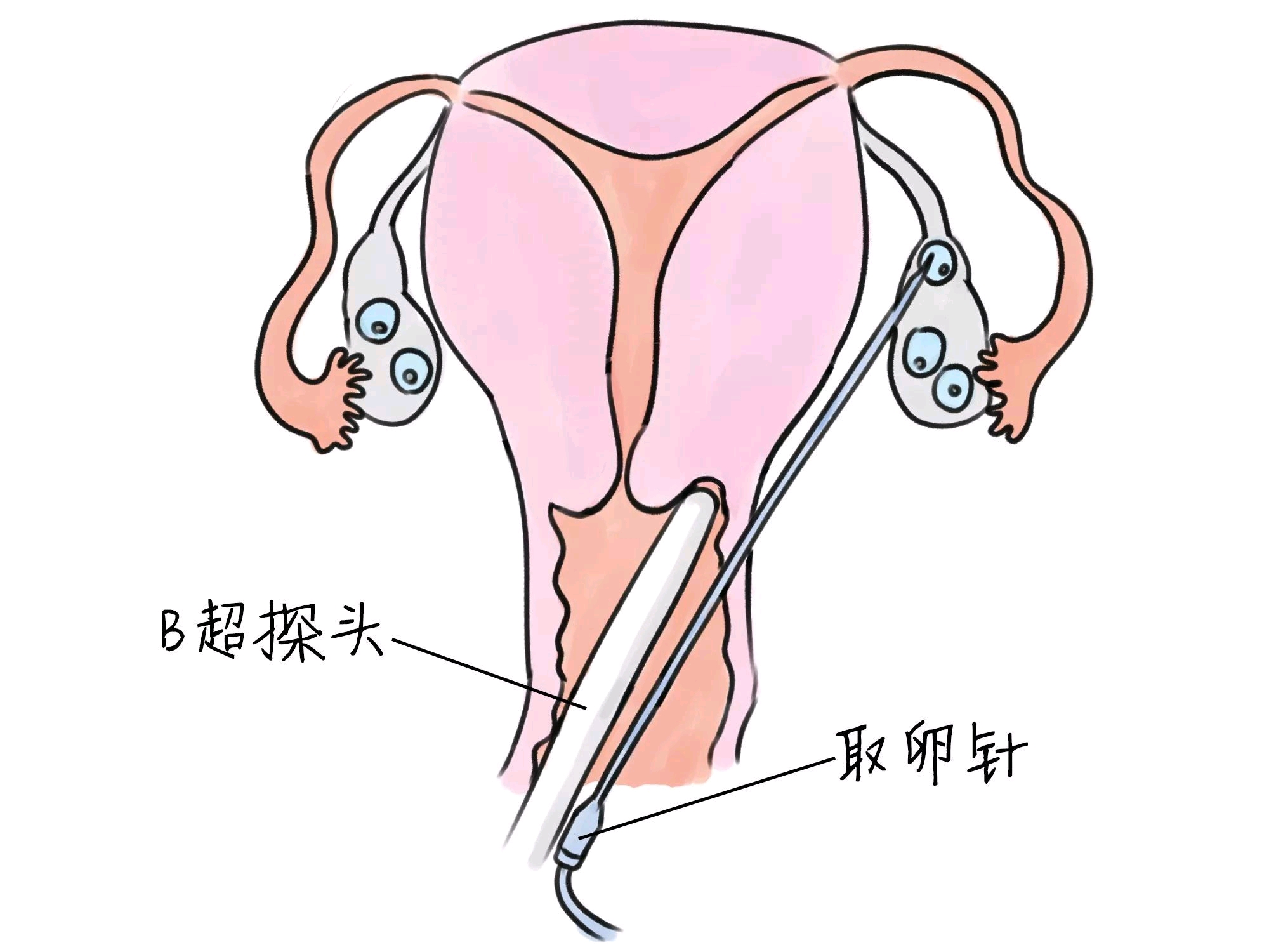 北京朝阳医院试管婴儿